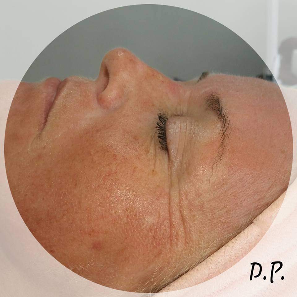 Linke Gesichtshälfte ohne Microneedling 