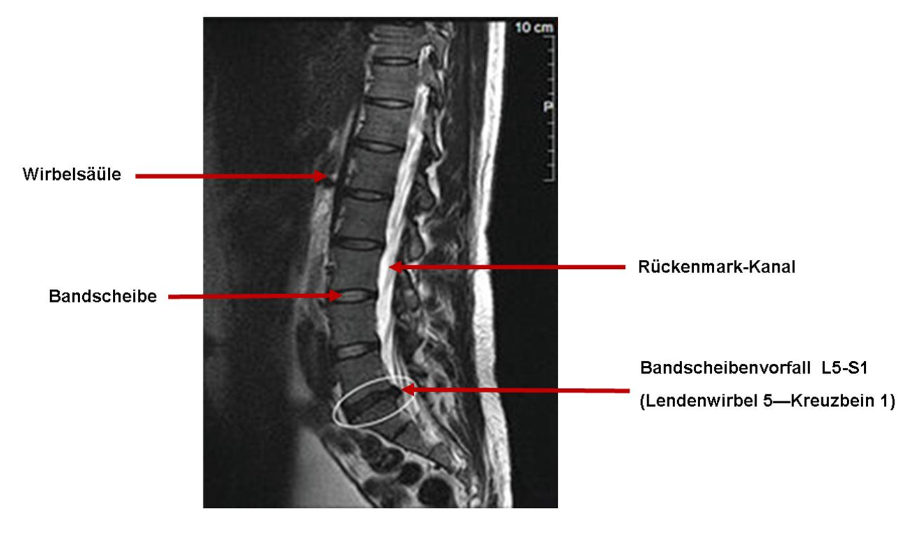 Info Bandscheibenvorfall Chiropraktik Frank Leimann