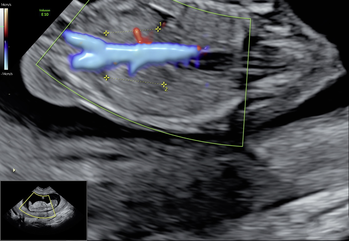 Vortrag: Update zum Ersttrimesterscreening