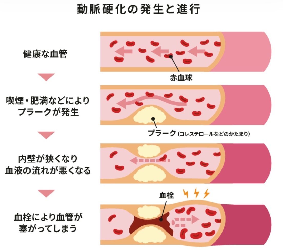 LDL（悪玉）コレステロール増加によって起こる病気は？