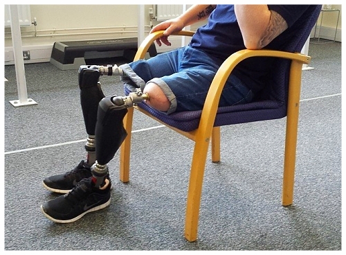 Osseointegration can be a viable alternative to traditional prosthetic sockets for lower limb amputees (picture courtesy of Pace Rehab) 