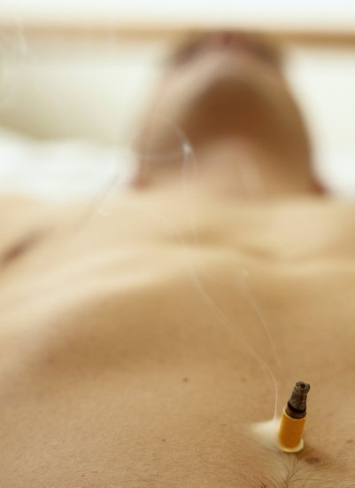 Moxibustion abdominale avec moxas autocollant.