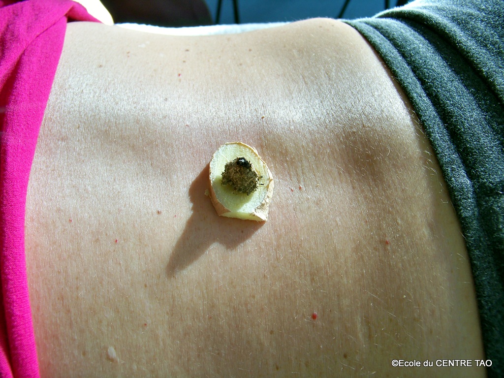 Moxibustion sur tranche de gingembre.