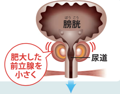 勃起不全トロント