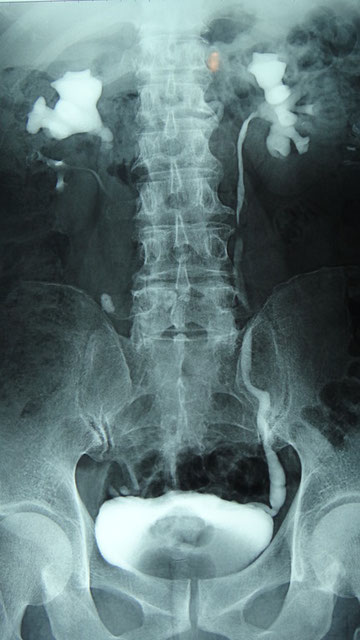 尿管結石 Chapter-2 尿管 尿路結石｜超音波検査法セミナー