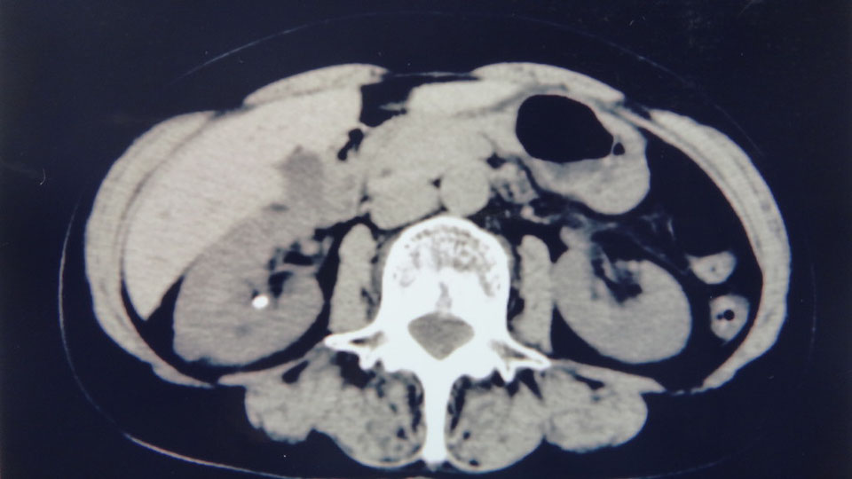 腎結石　CT画像