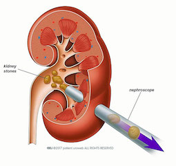 traitement per-cutané des calculs rénaux