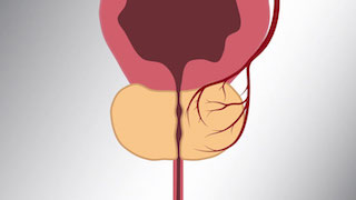 embolisation prostatique