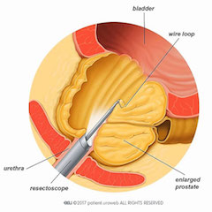 resection endoscopique de la prostate
