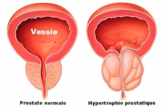hypertrophie de la prostate