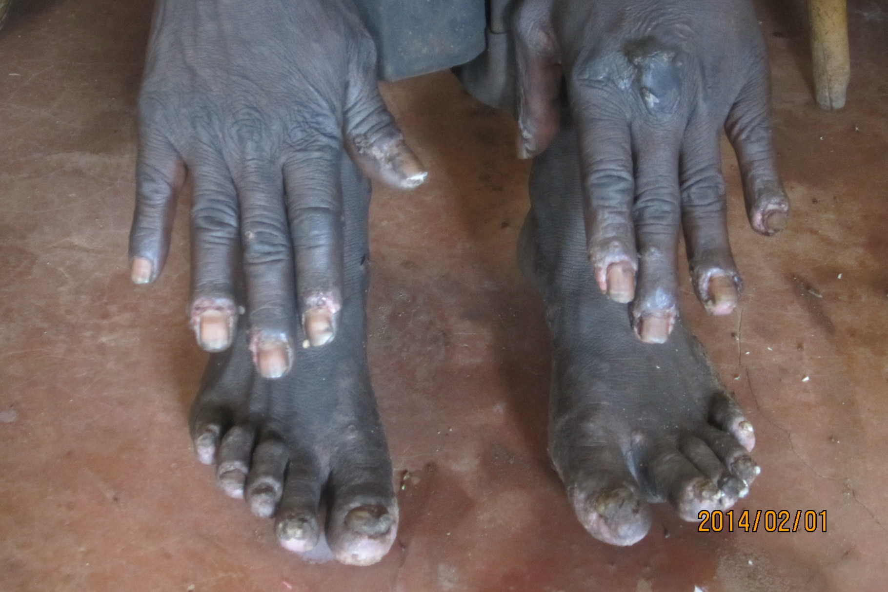 Was sind Jiggers und warum ist Hilfe für die Opfer wichtig? Maisha