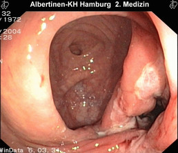 entzündeter Darm bei Morbus Crohn