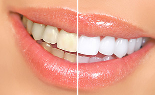 Wie viel weißer werden die Zähne durch Bleaching?