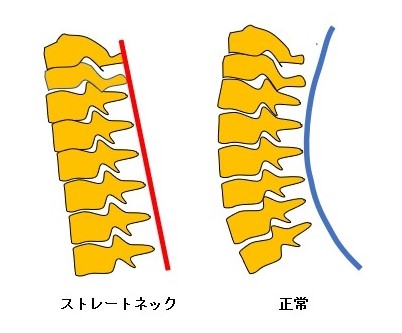 ストレートネックと頚椎の正常なアライメント