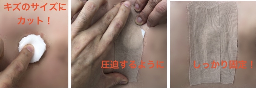 出血している時の、ガーゼ貼り方
