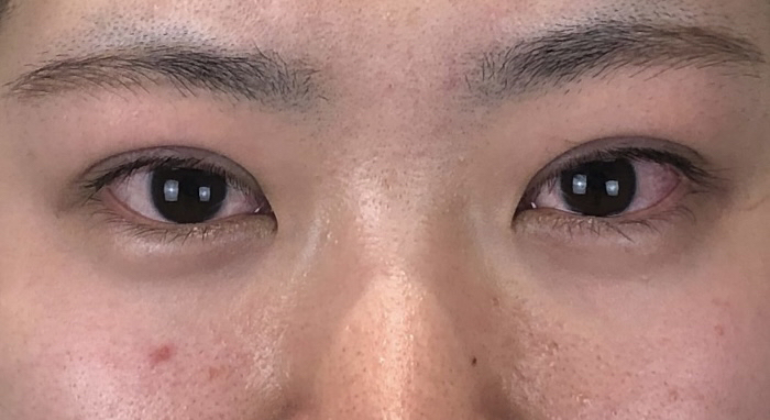 埋没4点法の画像