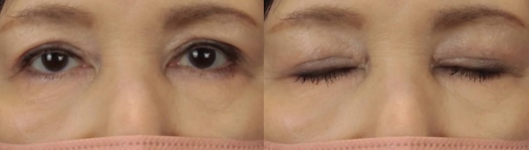 眼瞼下垂症手術の画像