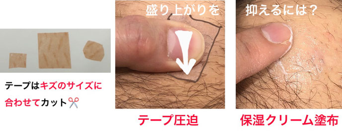 キズアトの盛り上がりを抑えるための、テープ保護と保湿クリーム塗布