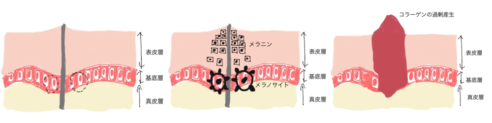 図2 : 左 : 白いキズアト 中: 黒いキズアト 右 : 赤いキズアト