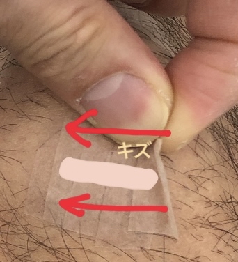 キズに貼るテープの剥がし方
