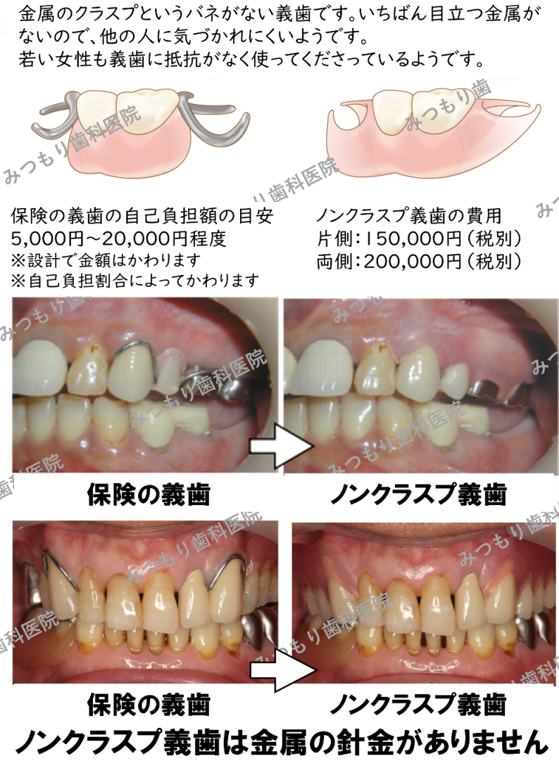ノンクラスプ義歯は金属のクラスプというバネ（針金）がない義歯です。いちばん目立つ金属がないので、他の人に気づかれにくいようです。若い女性も義歯に抵抗がなく使ってくださっているようです。