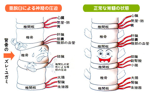 歪みによる神経伝達悪化