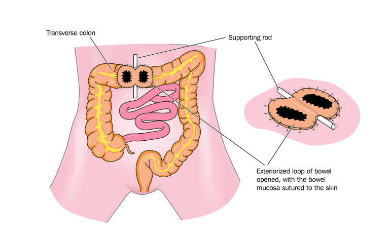 Colostomy: Variations in Structural Methodology