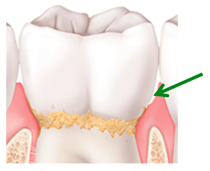 Ursachen für Zahnfleischtaschen und was Sie jetzt dagegen tun können! - Bambus Zahnbürsten & Bio ...