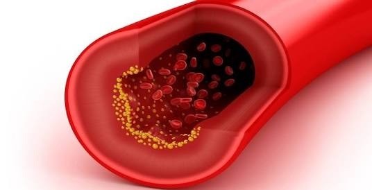 Síntomas que indican la presencia del colesterol alto