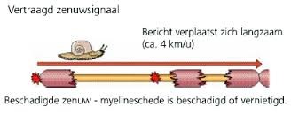 Beschadigde zenuw, vb Guillain-Barré syndroom (GBS)