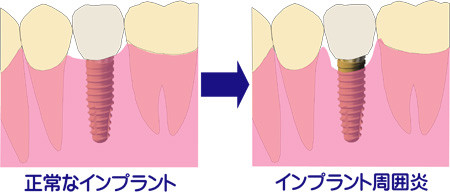 正常なインプラントとインプラント周囲炎