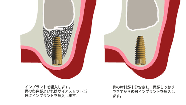 サイナスリフト６