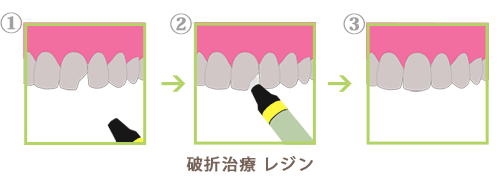 破折治療レジン