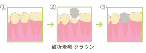 破折治療　クラウン