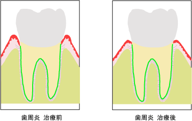 歯肉炎治療前・歯肉炎治療後