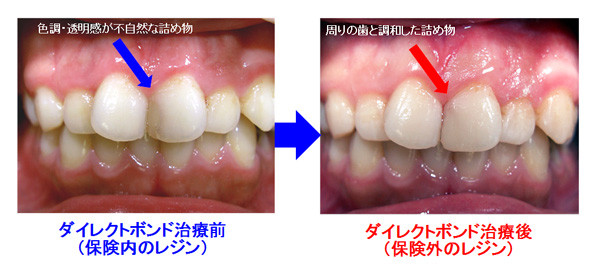 ダイレクトボンド治療前　ダイレクトボンド治療後