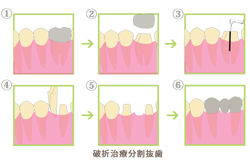 破折治療分割抜歯