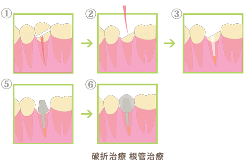 破折治療　根管治療