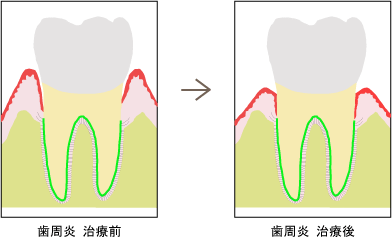 歯周炎治療前・歯周炎治療後