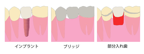 インプラント　ブリッジ　部分入れ歯比較