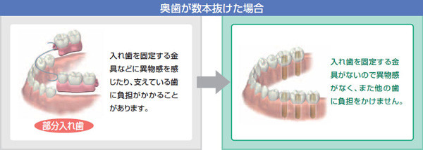 奥歯が数本抜けた時