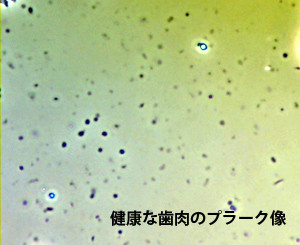 健康な歯肉のプラーク像