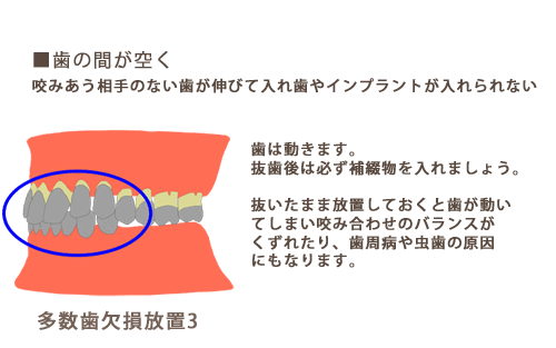 歯の間が空く　嚙みあう相手のない歯が伸びて入れ歯やインプラントが入れられない