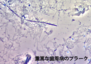 重篤な歯周病のプラーク