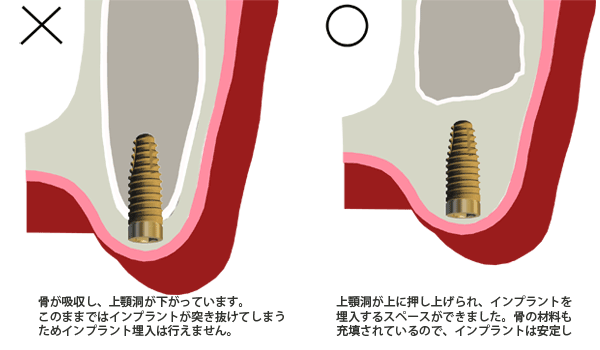 サイナスリフト７