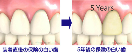 保険の白い歯の５年後