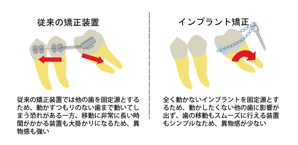 従来の矯正装置とインプラント矯正