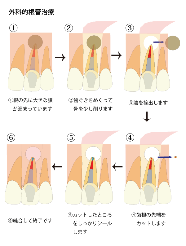 外科的根管治療