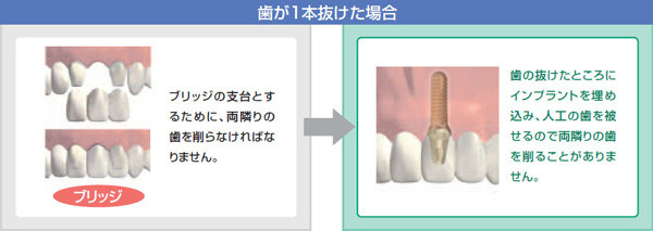 歯が１本抜けた場合