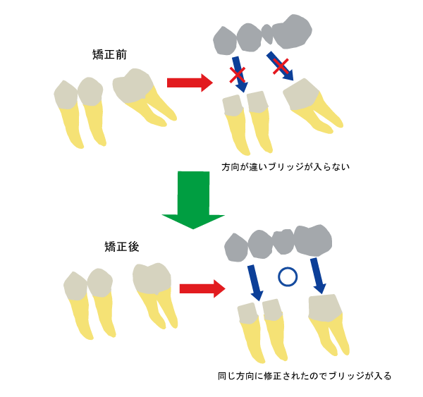 ブリッジアップライト・アップライト症例